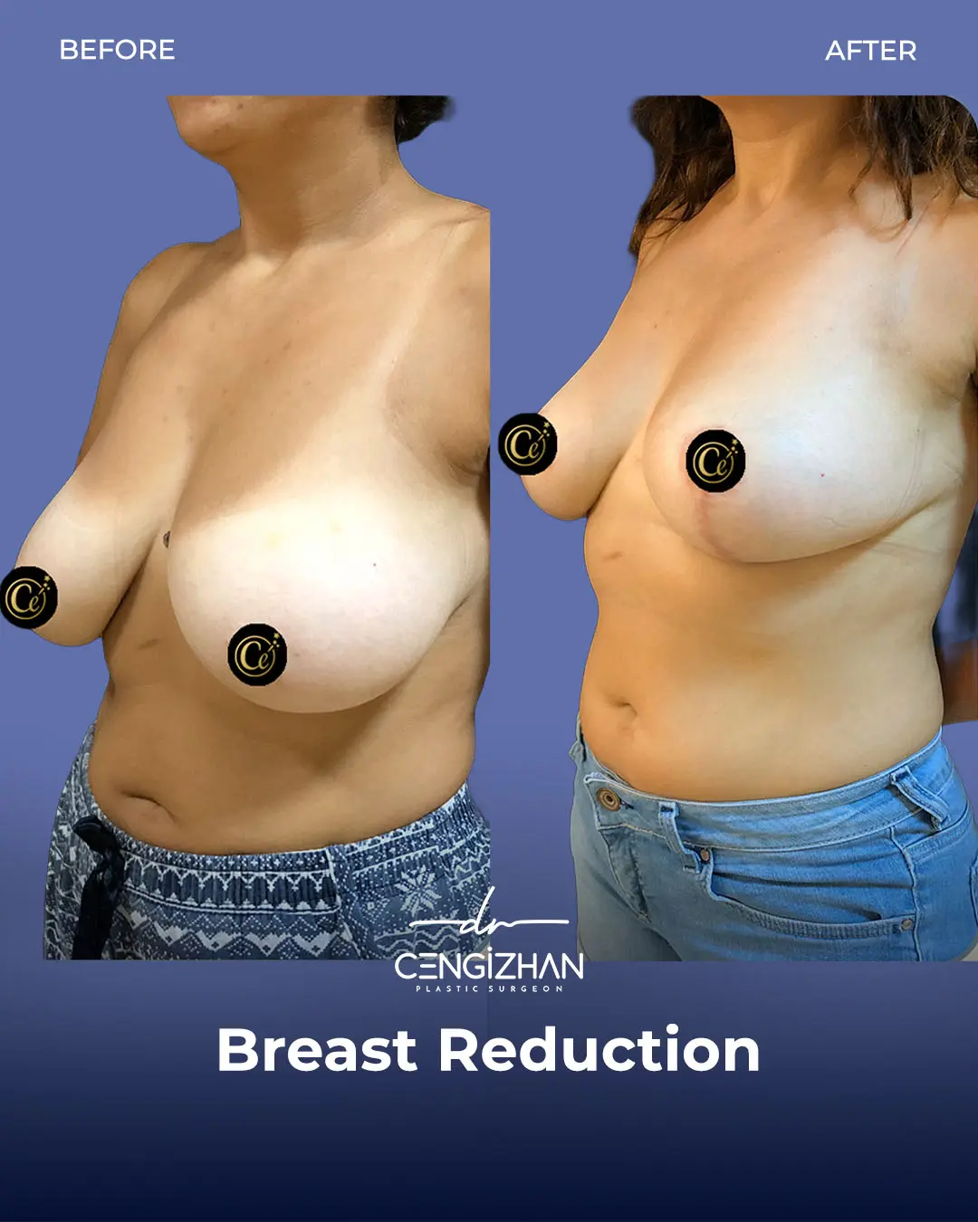Breast Reduction Before and after photo by Dr. Cengizhan Ekizceli