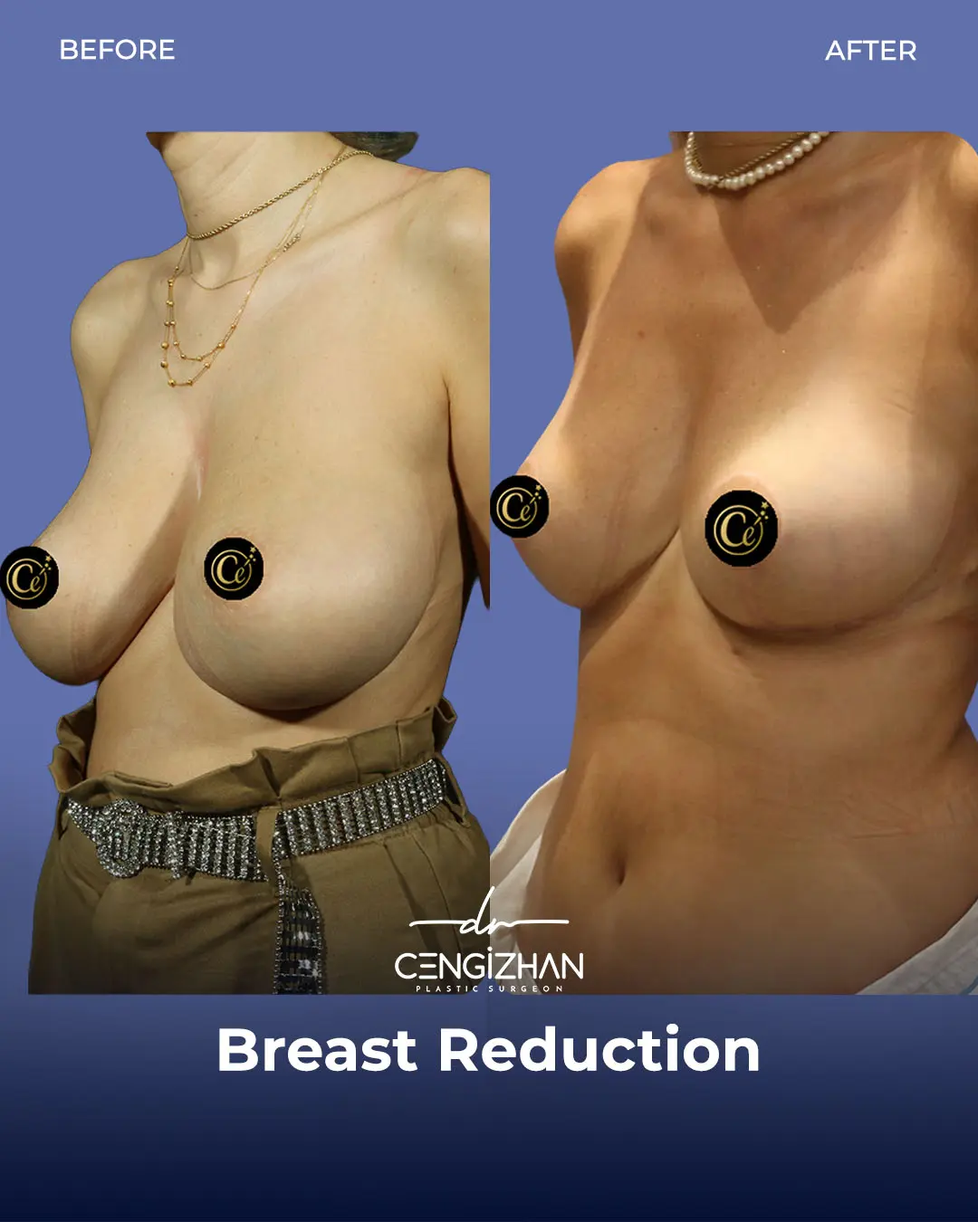 Breast Reduction Before and after photo by Dr. Cengizhan Ekizceli
