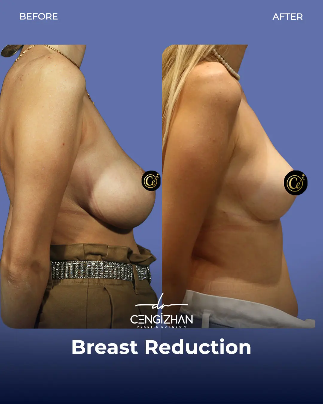 Breast Reduction Before and after photo by Dr. Cengizhan Ekizceli