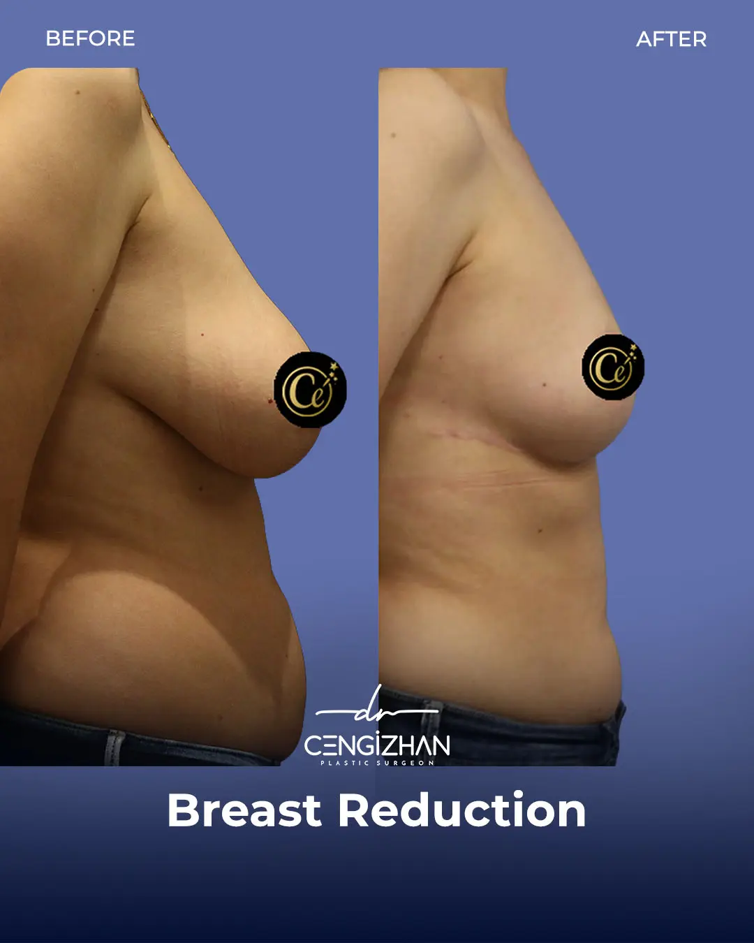 Breast Reduction Before and after photo by Dr. Cengizhan Ekizceli