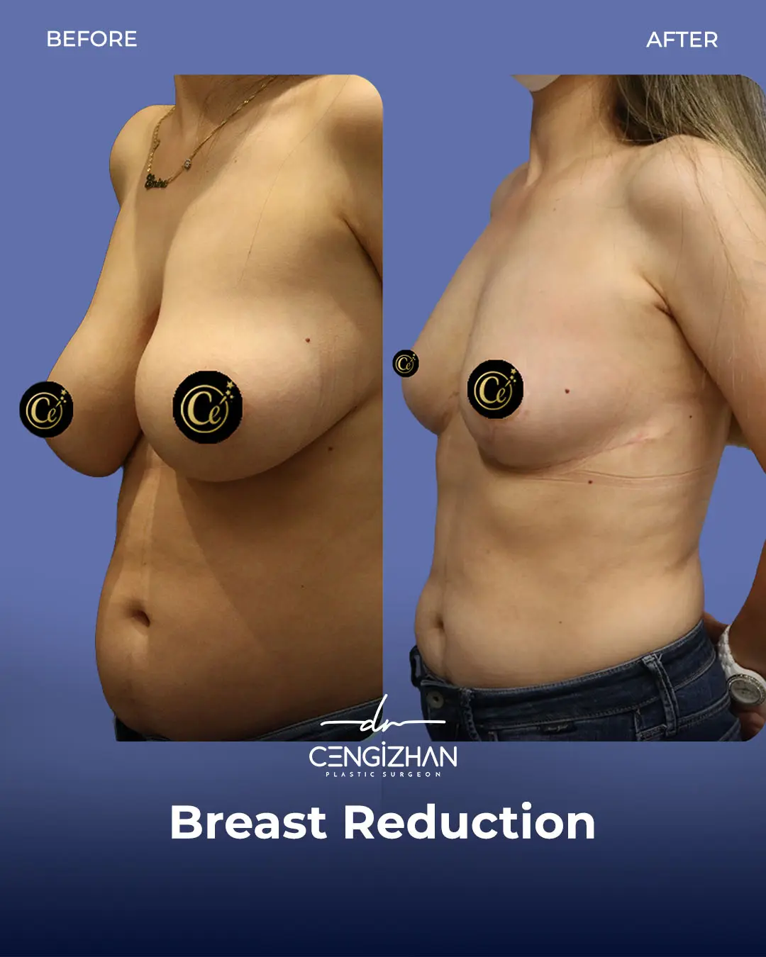 Breast Reduction Before and after photo by Dr. Cengizhan Ekizceli
