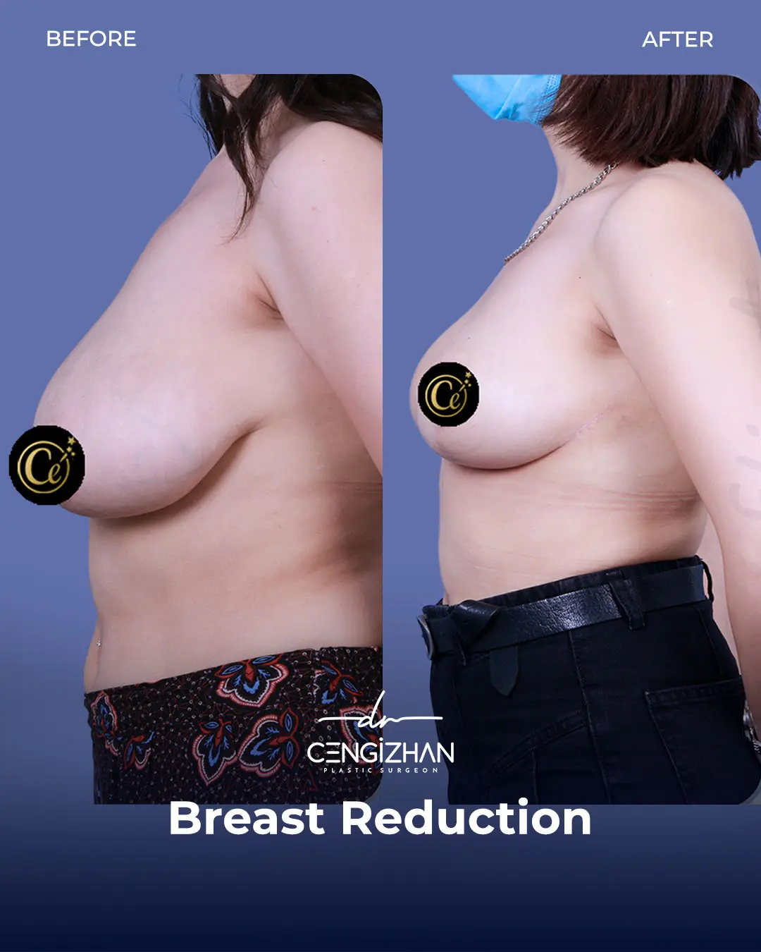 Breast Reduction Before and after photo by Dr. Cengizhan Ekizceli