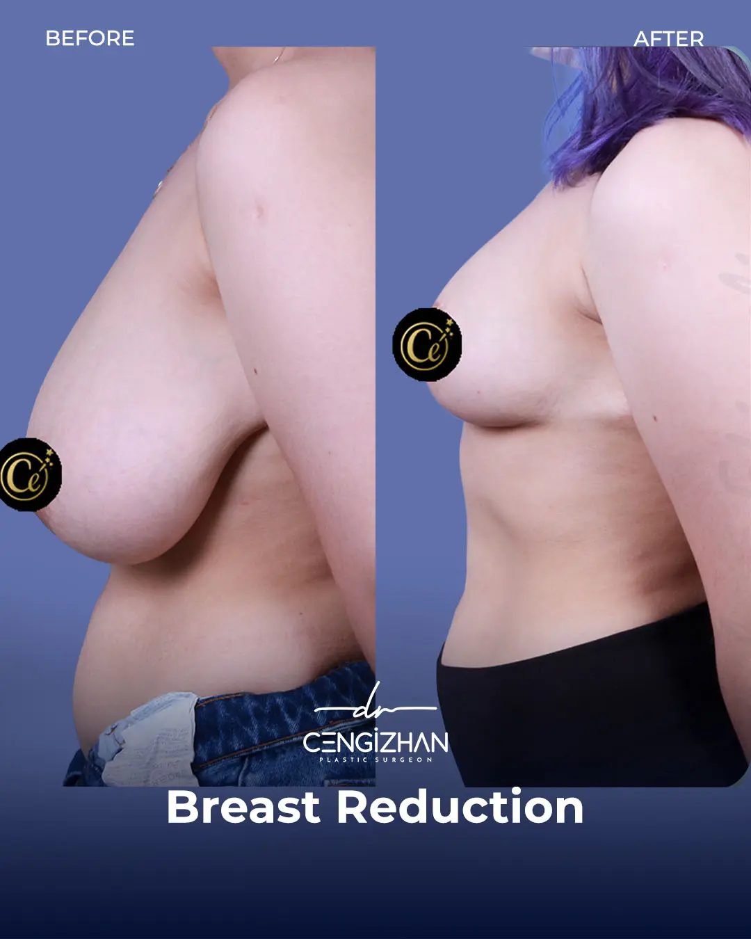 Breast Reduction Before and after photo by Dr. Cengizhan Ekizceli