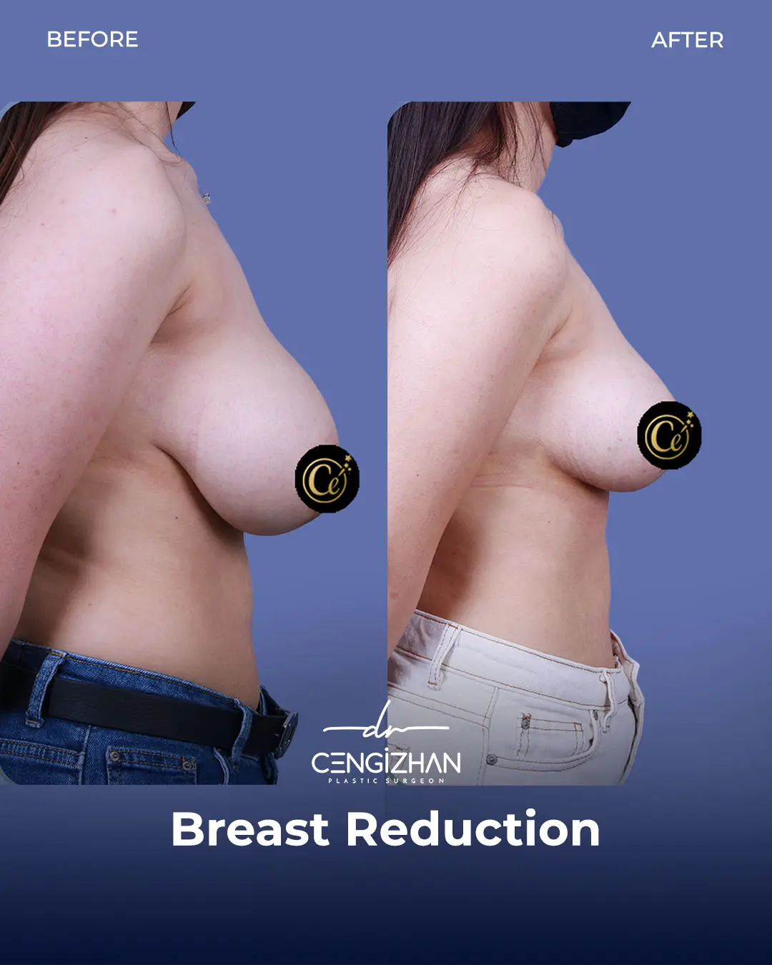 Breast Reduction Before and after photo by Dr. Cengizhan Ekizceli