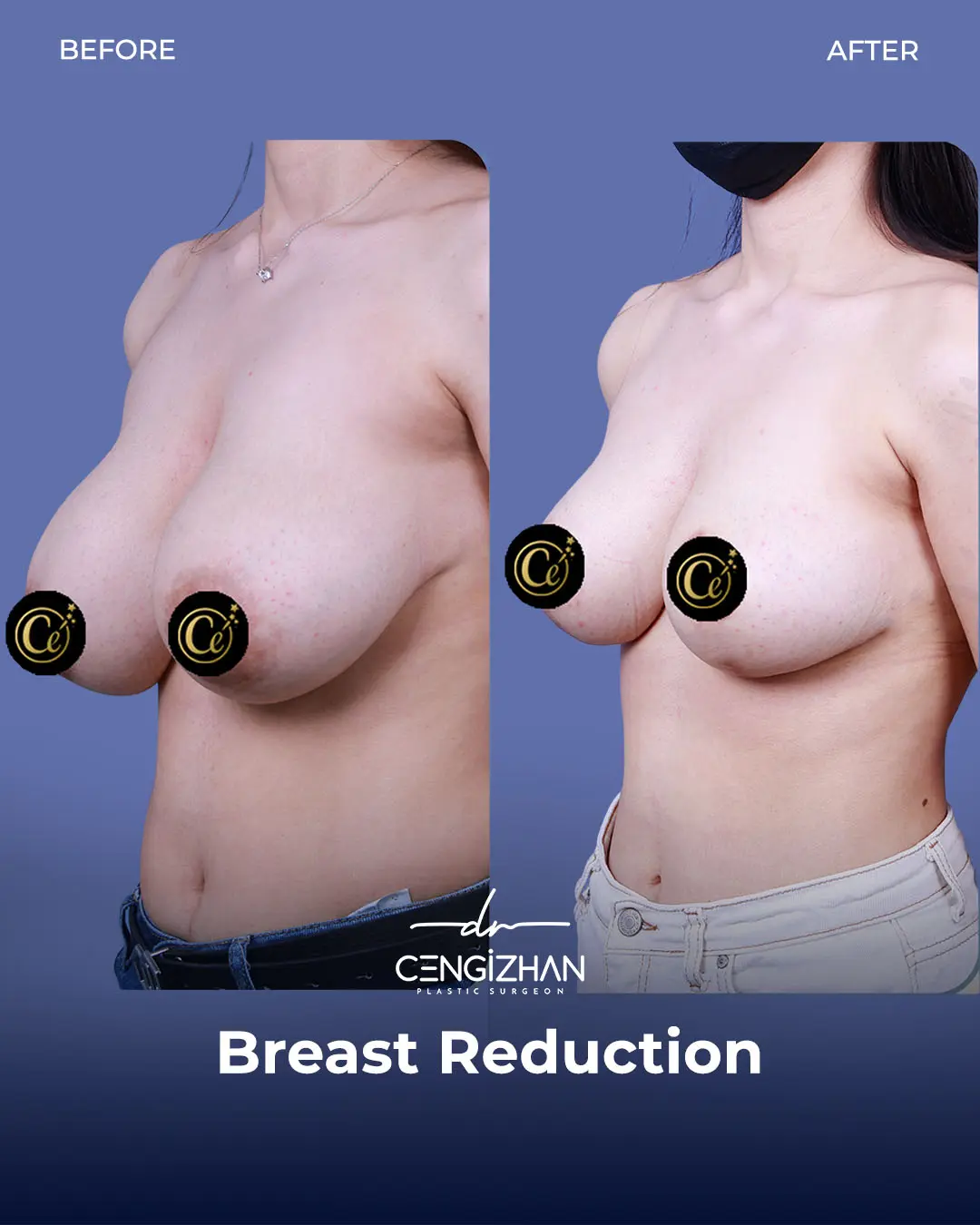Breast Reduction Before and after photo by Dr. Cengizhan Ekizceli