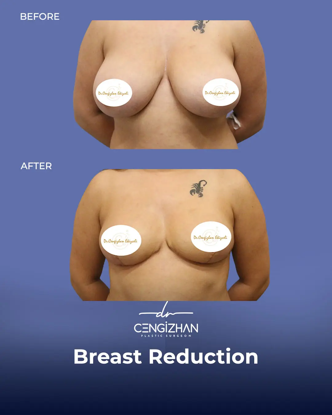 Breast Reduction Before and after photo by Dr. Cengizhan Ekizceli