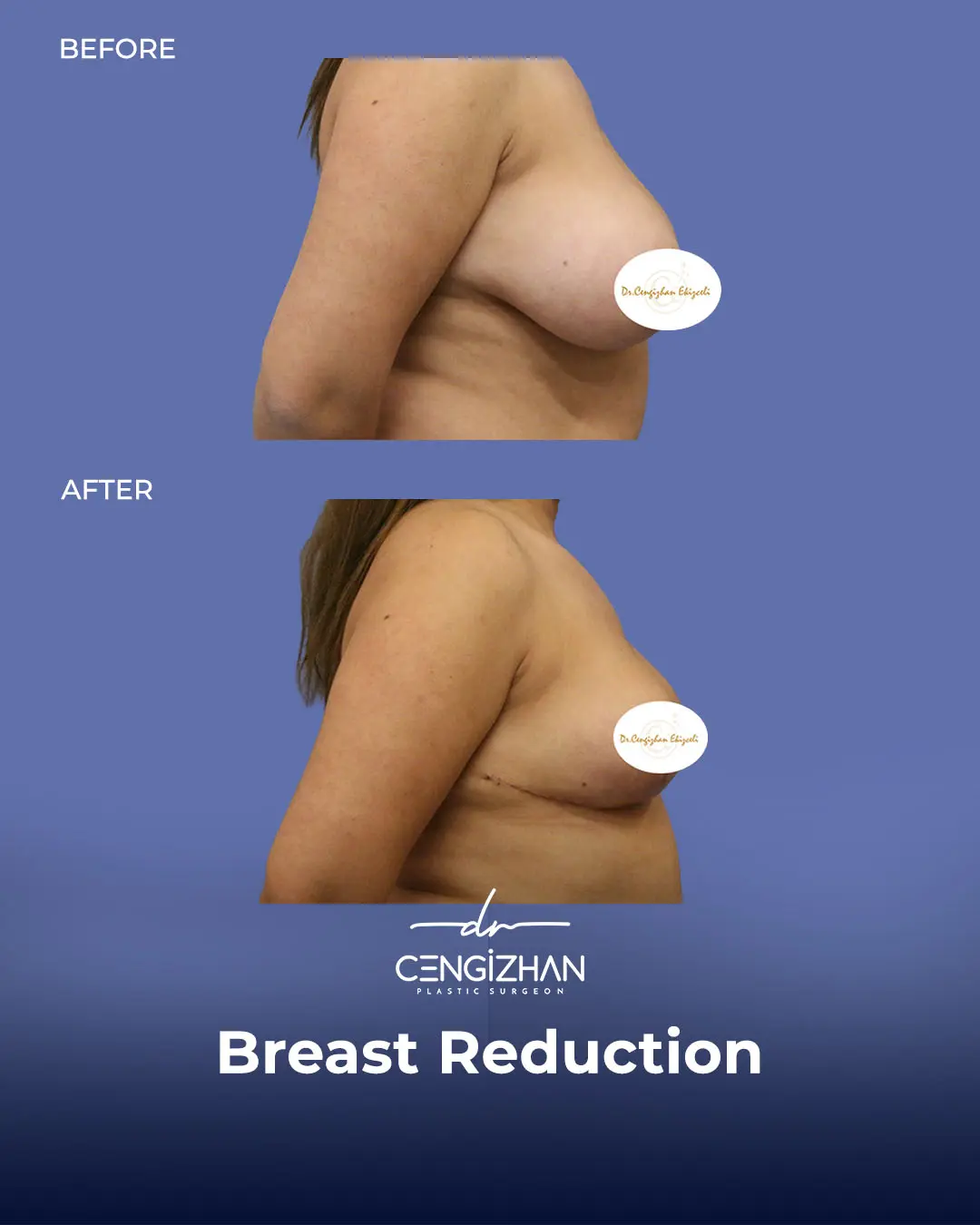 Breast Reduction Before and after photo by Dr. Cengizhan Ekizceli