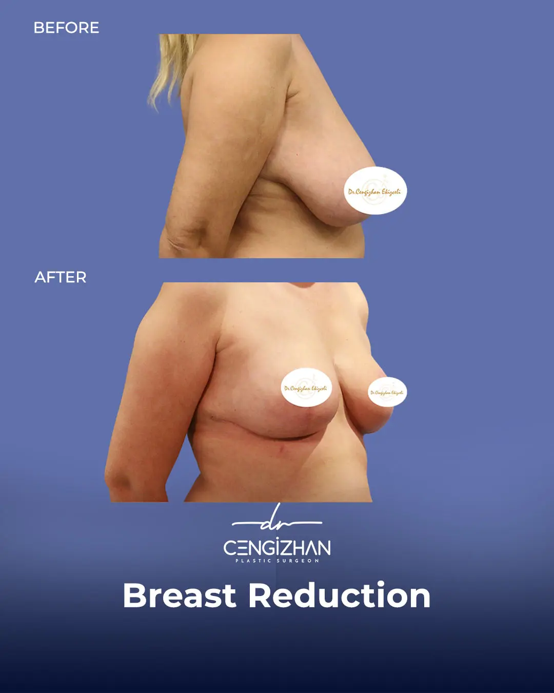 Breast Reduction Before and after photo by Dr. Cengizhan Ekizceli
