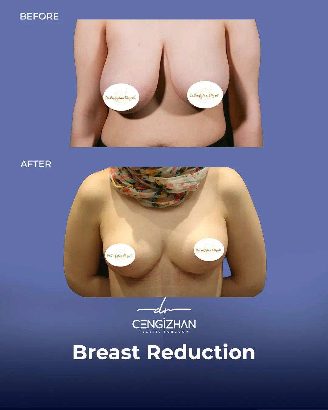 Breast Reduction Before and after photo by Dr. Cengizhan Ekizceli