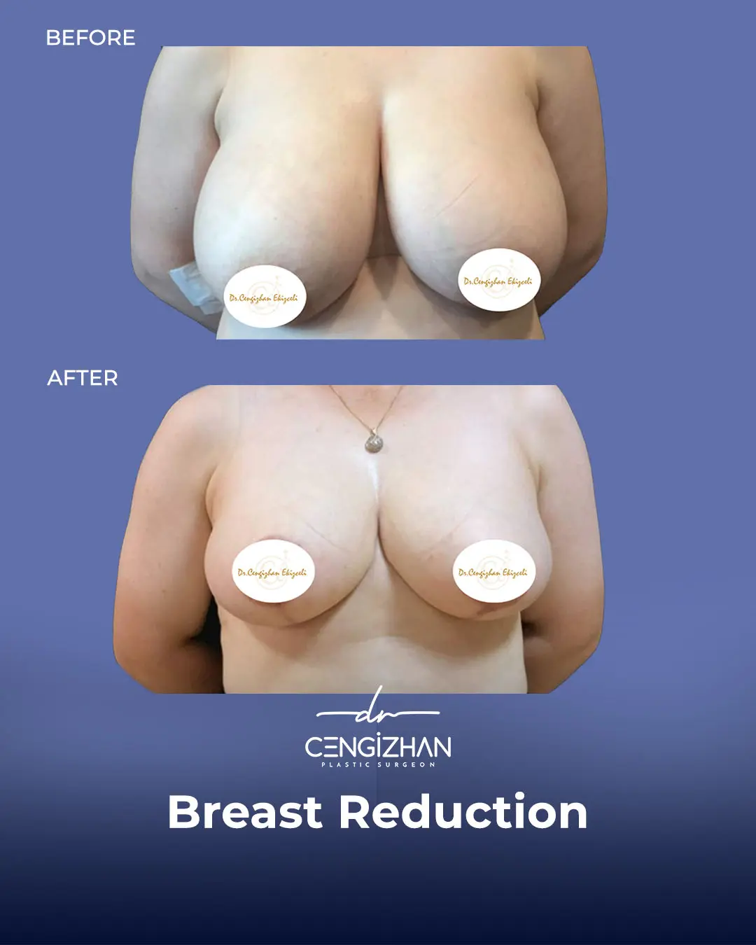 Breast Reduction Before and after photo by Dr. Cengizhan Ekizceli