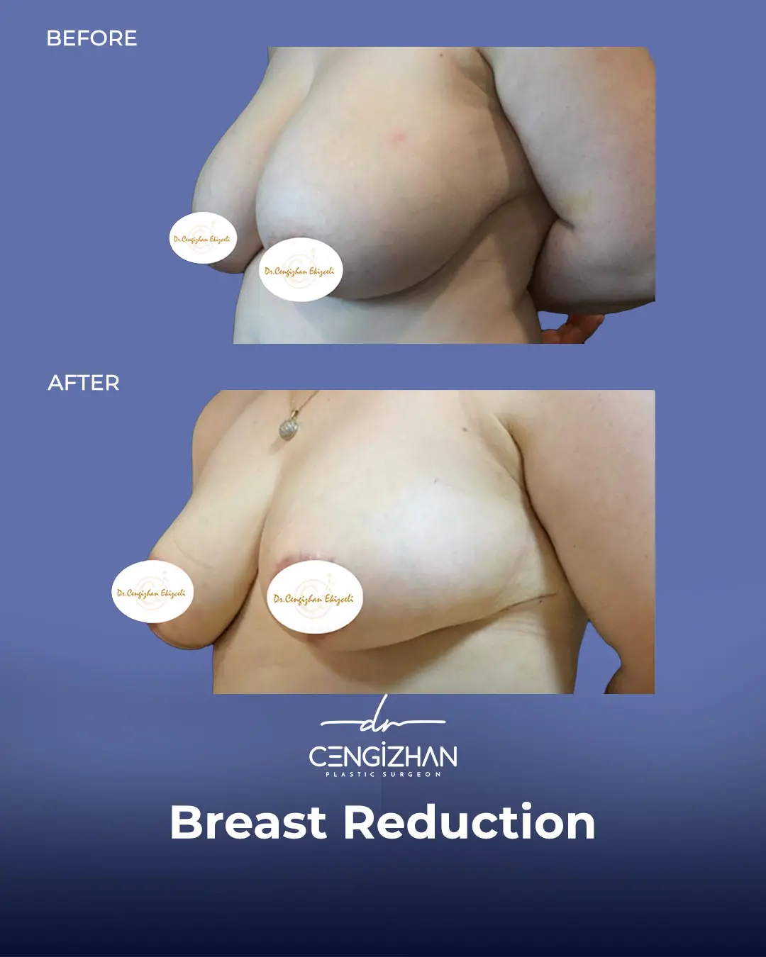 Breast Reduction Before and after photo by Dr. Cengizhan Ekizceli