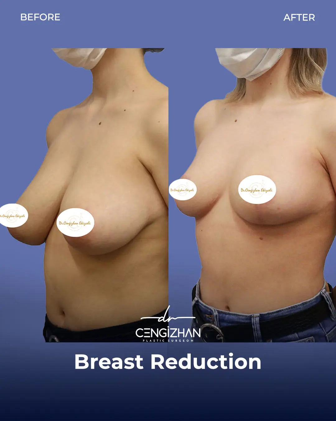 Breast Reduction Before and after photo by Dr. Cengizhan Ekizceli