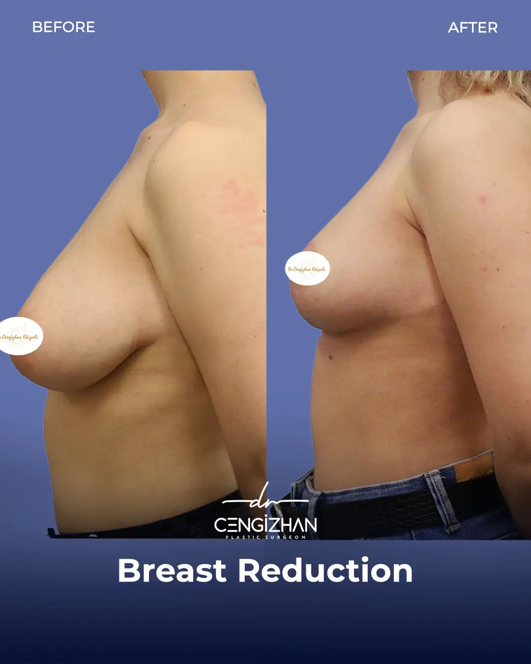 Breast Reduction Before and after photo by Dr. Cengizhan Ekizceli