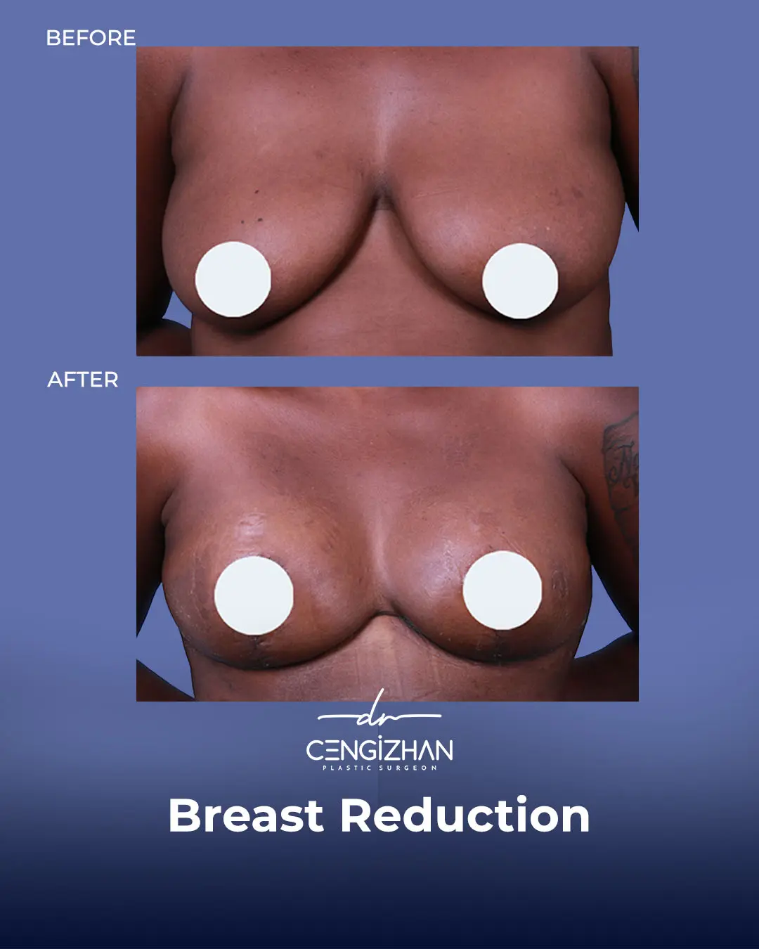 Breast Reduction Before and after photo by Dr. Cengizhan Ekizceli