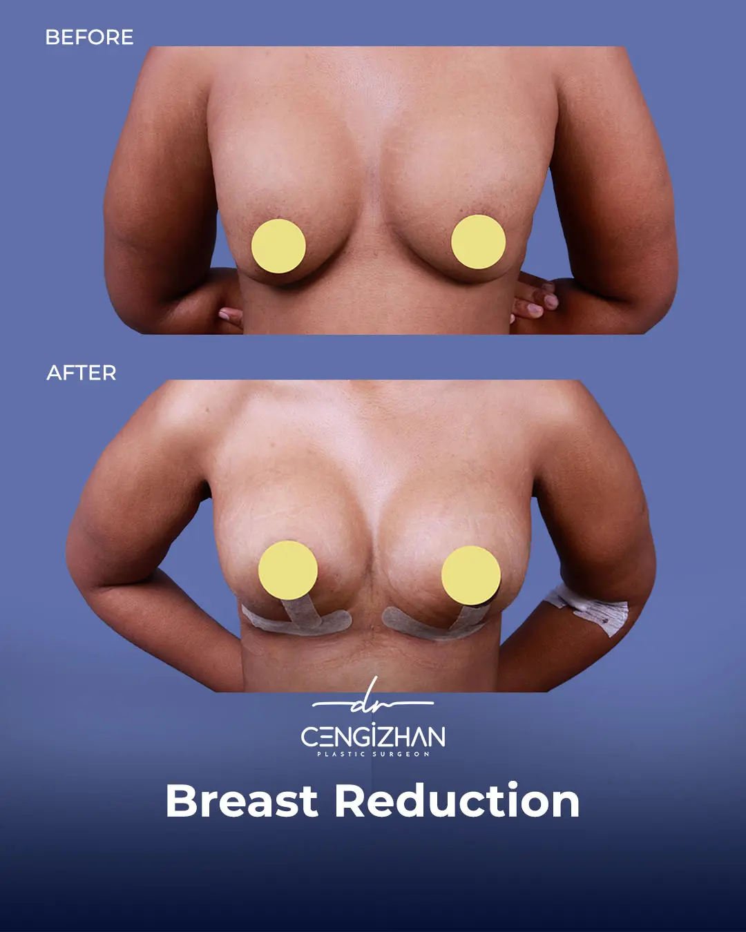 Breast Reduction Before and after photo by Dr. Cengizhan Ekizceli