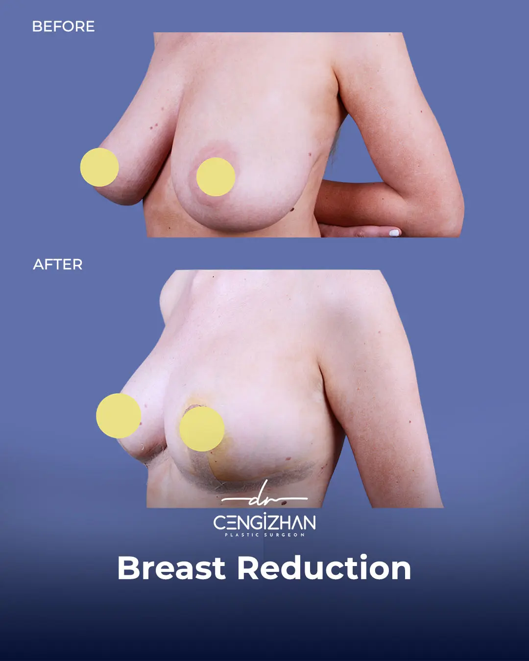 Breast Reduction Before and after photo by Dr. Cengizhan Ekizceli
