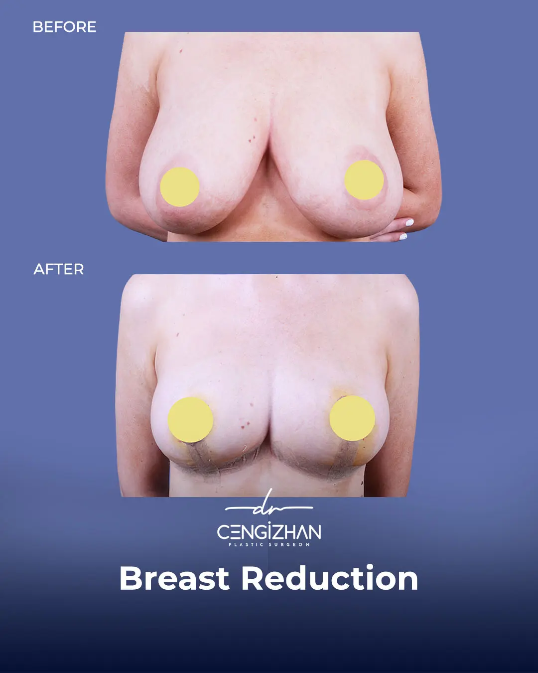 Breast Reduction Before and after photo by Dr. Cengizhan Ekizceli