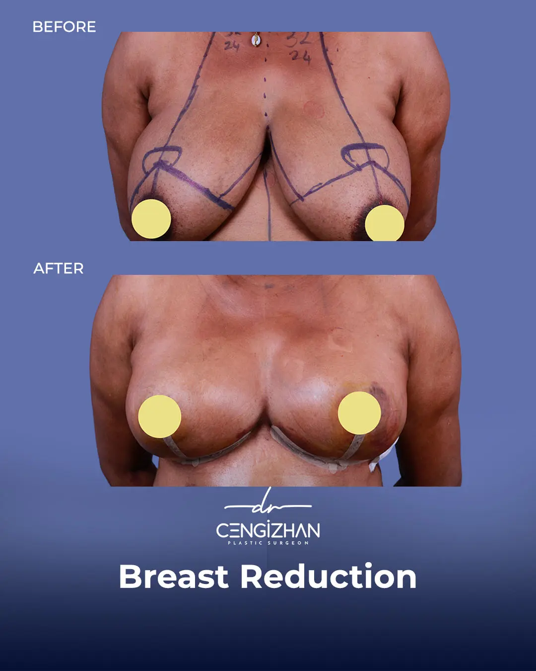 Breast Reduction Before and after photo by Dr. Cengizhan Ekizceli