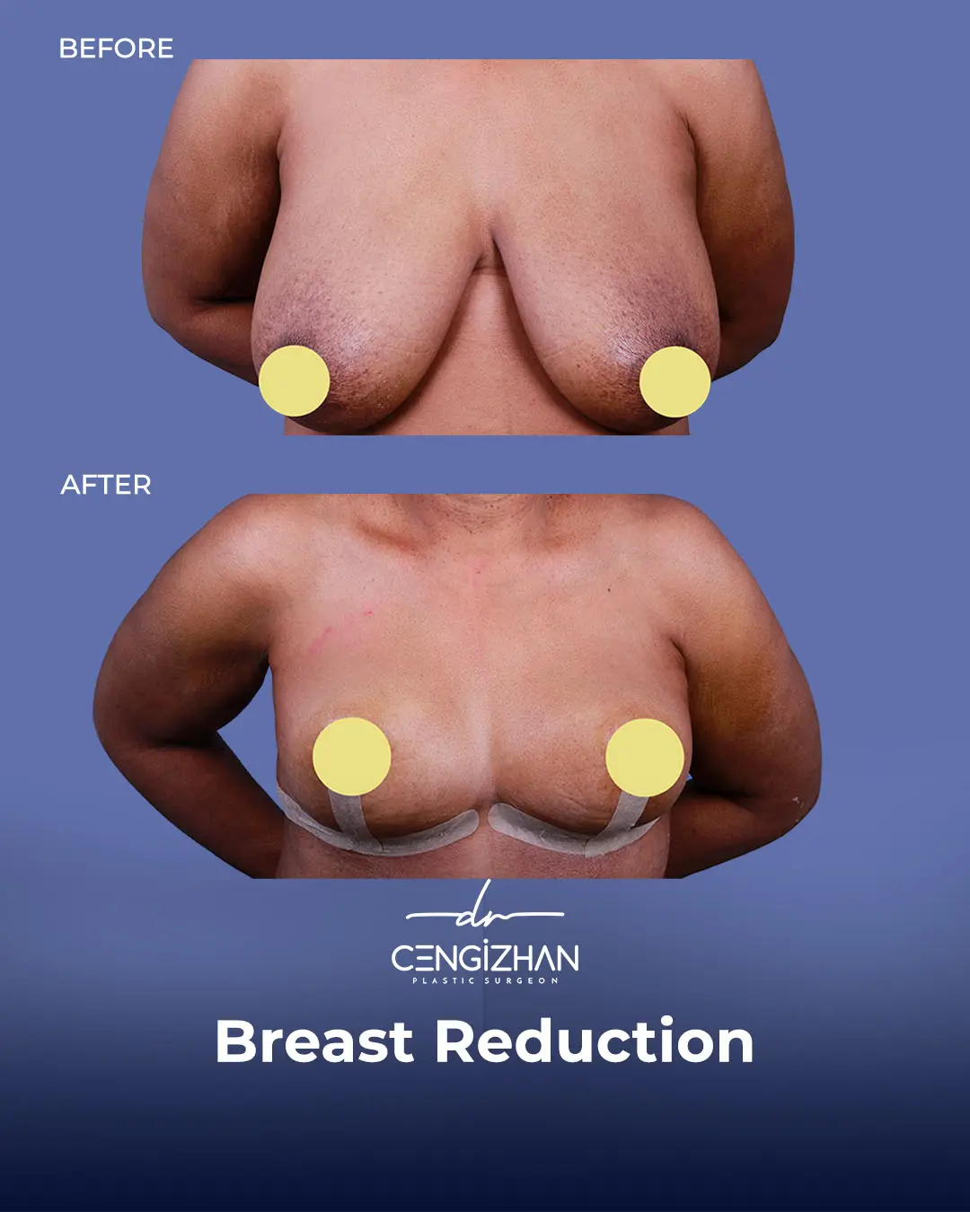 Breast Reduction Before and after photo by Dr. Cengizhan Ekizceli