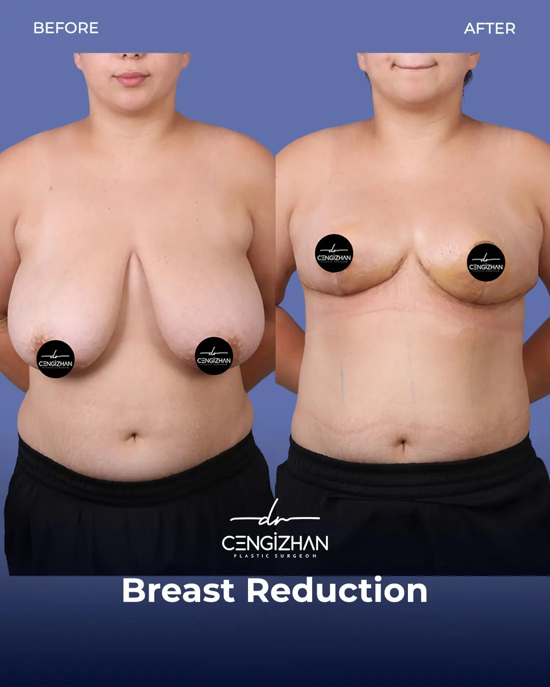 Breast Reduction Before and after photo by Dr. Cengizhan Ekizceli