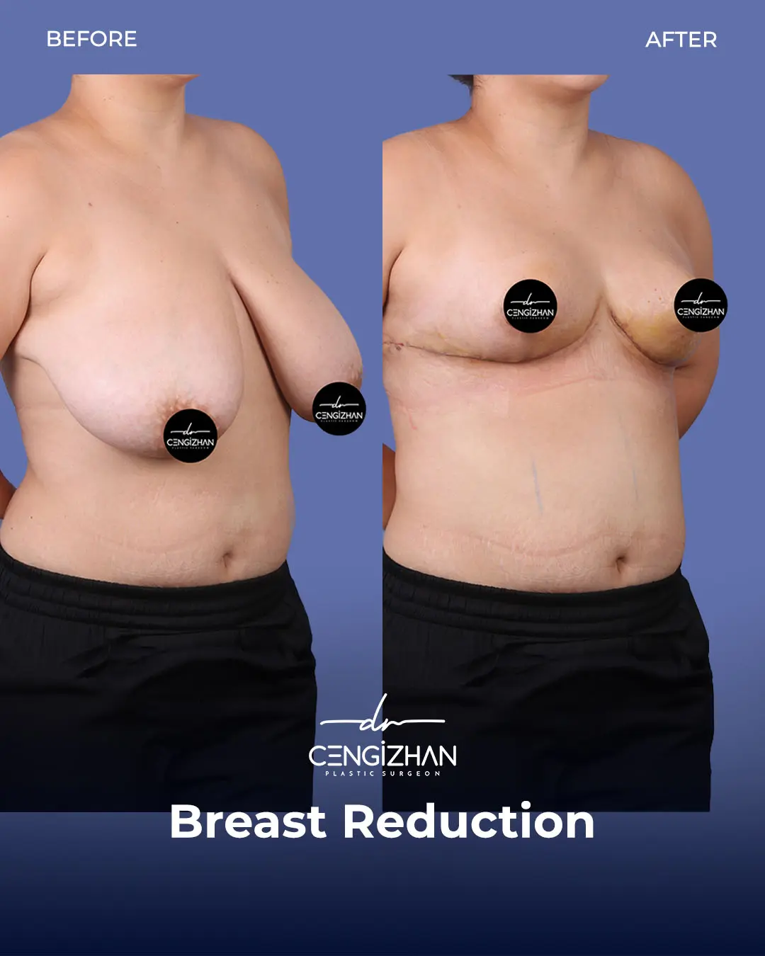 Breast Reduction Before and after photo by Dr. Cengizhan Ekizceli
