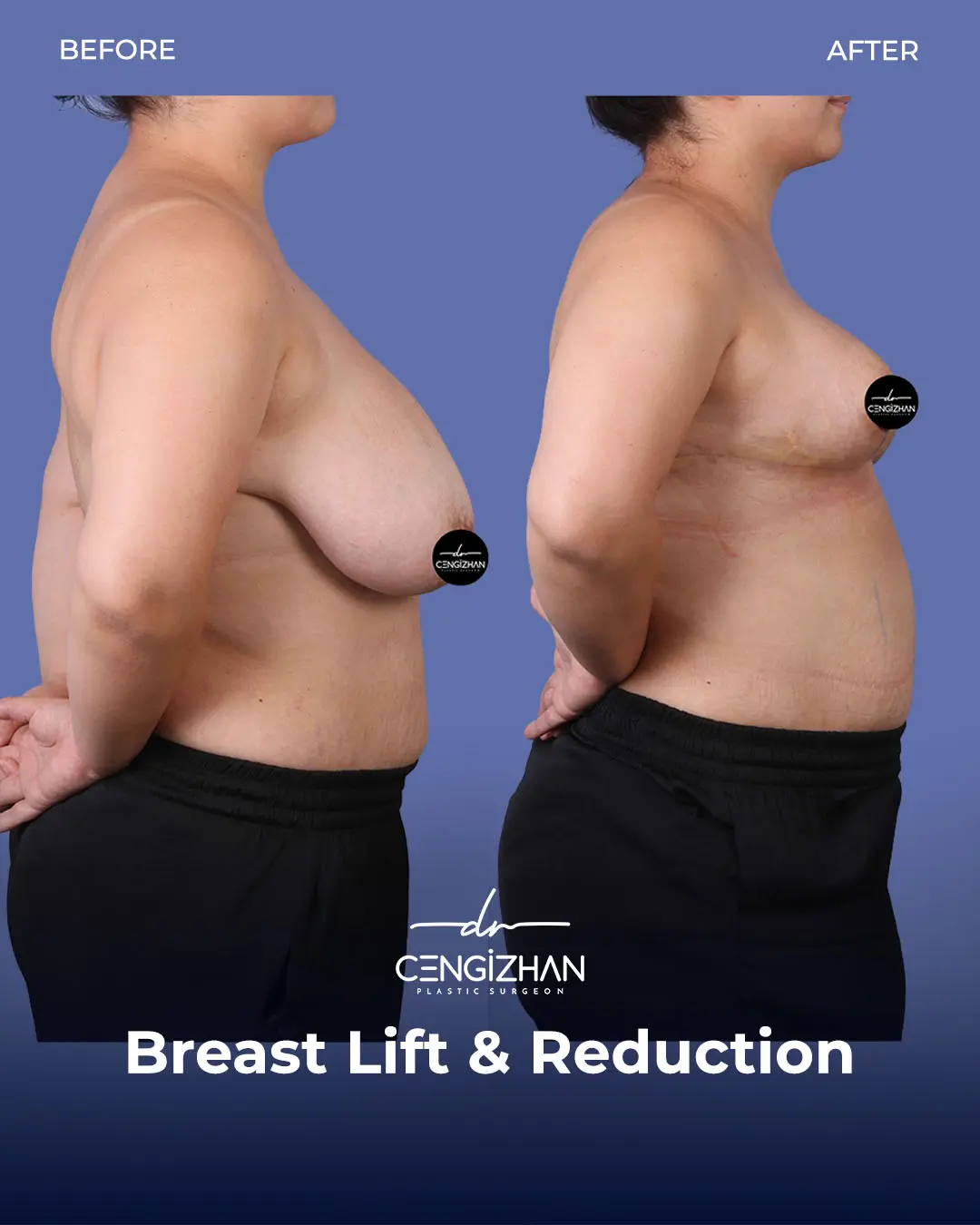 Breast Lift and Reduction Before and after photo by Dr. Cengizhan Ekizceli