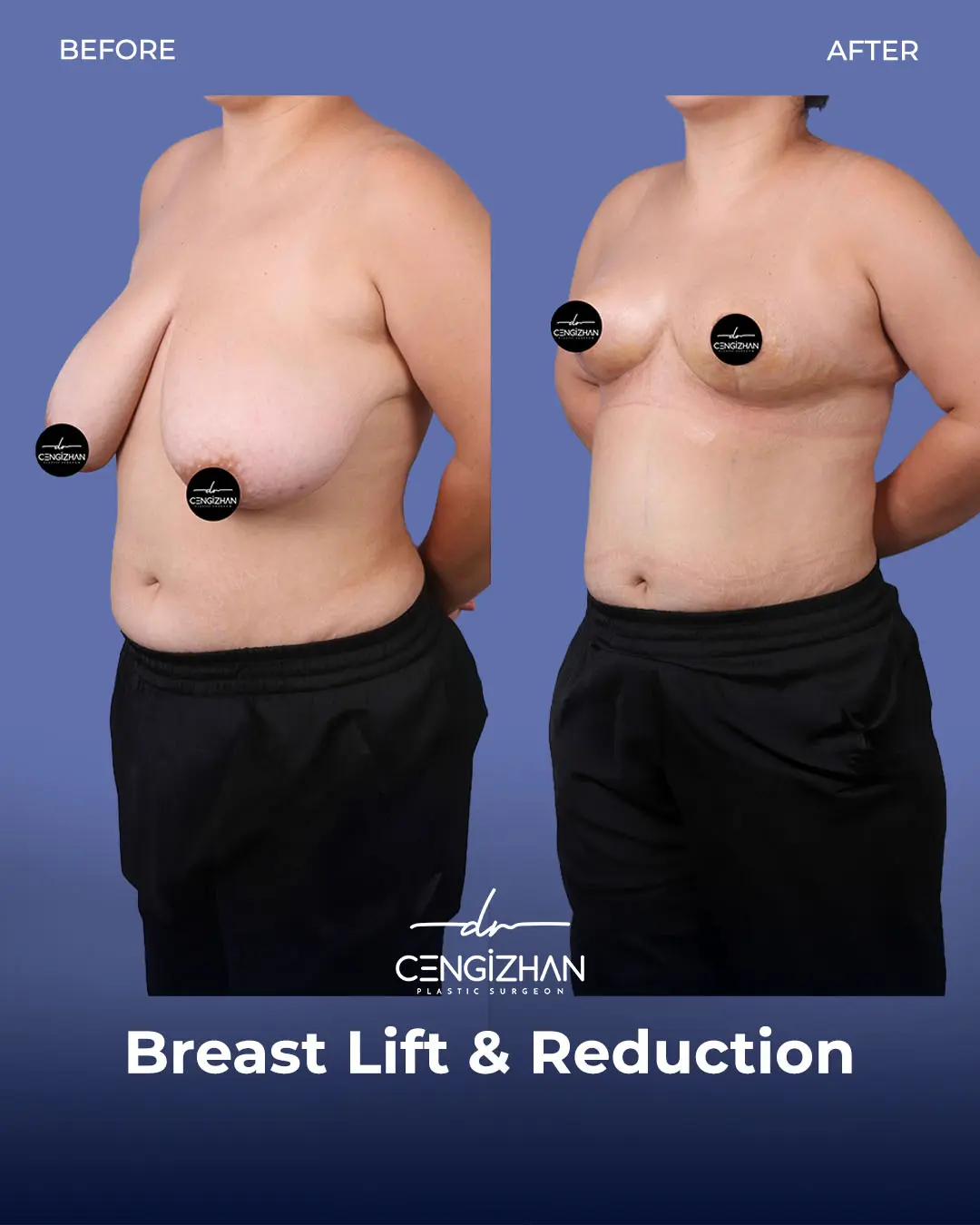 Breast Lift and Reduction Before and after photo by Dr. Cengizhan Ekizceli