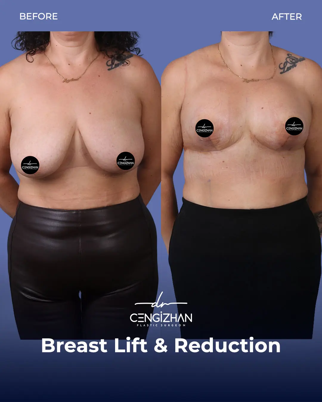 Breast Lift and Reduction Before and after photo by Dr. Cengizhan Ekizceli