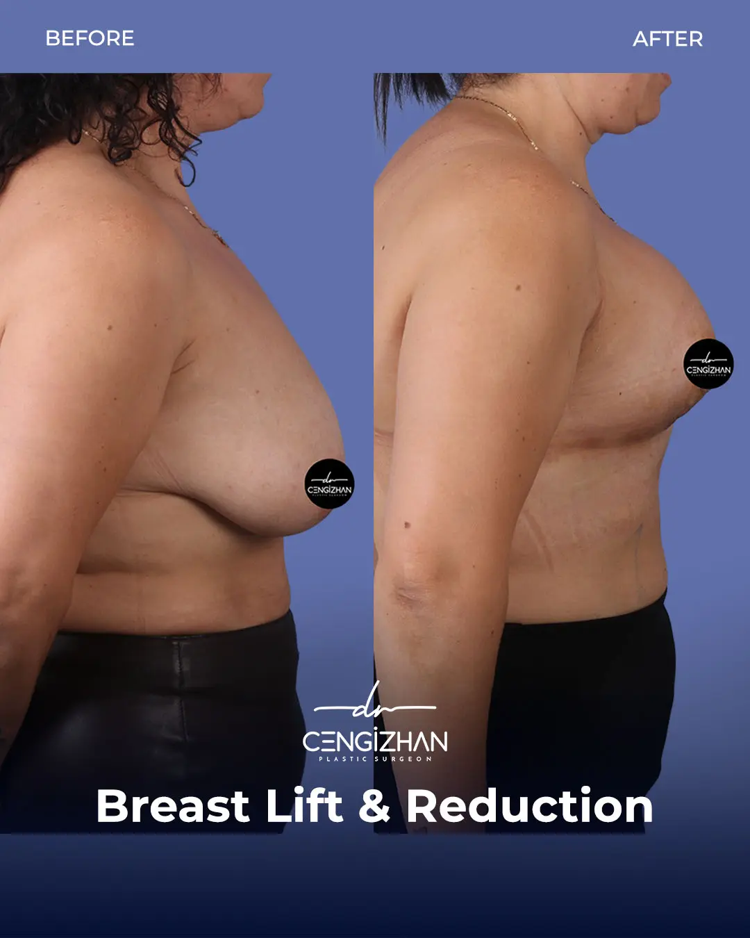 Breast Lift and Reduction Before and after photo by Dr. Cengizhan Ekizceli