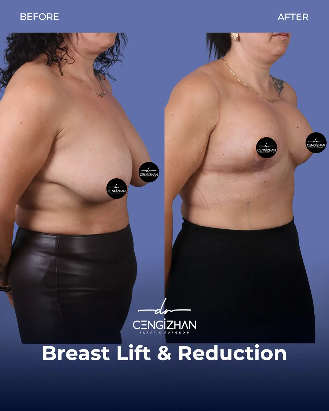 Breast Lift and Reduction Before and after photo by Dr. Cengizhan Ekizceli