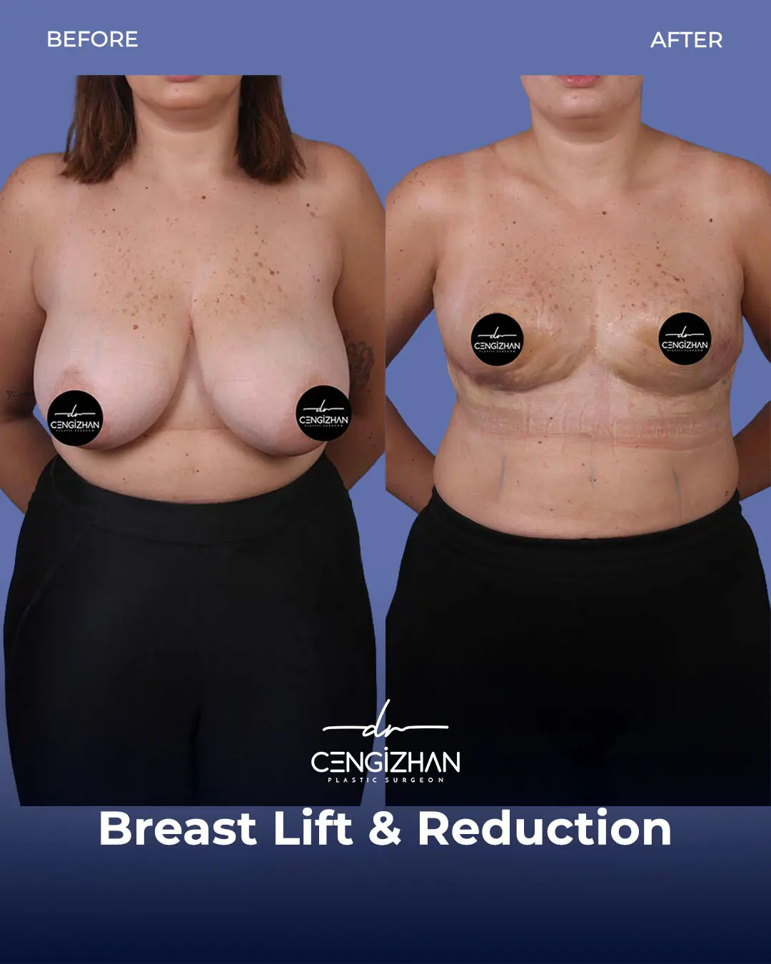 Breast Lift and Reduction Before and after photo by Dr. Cengizhan Ekizceli
