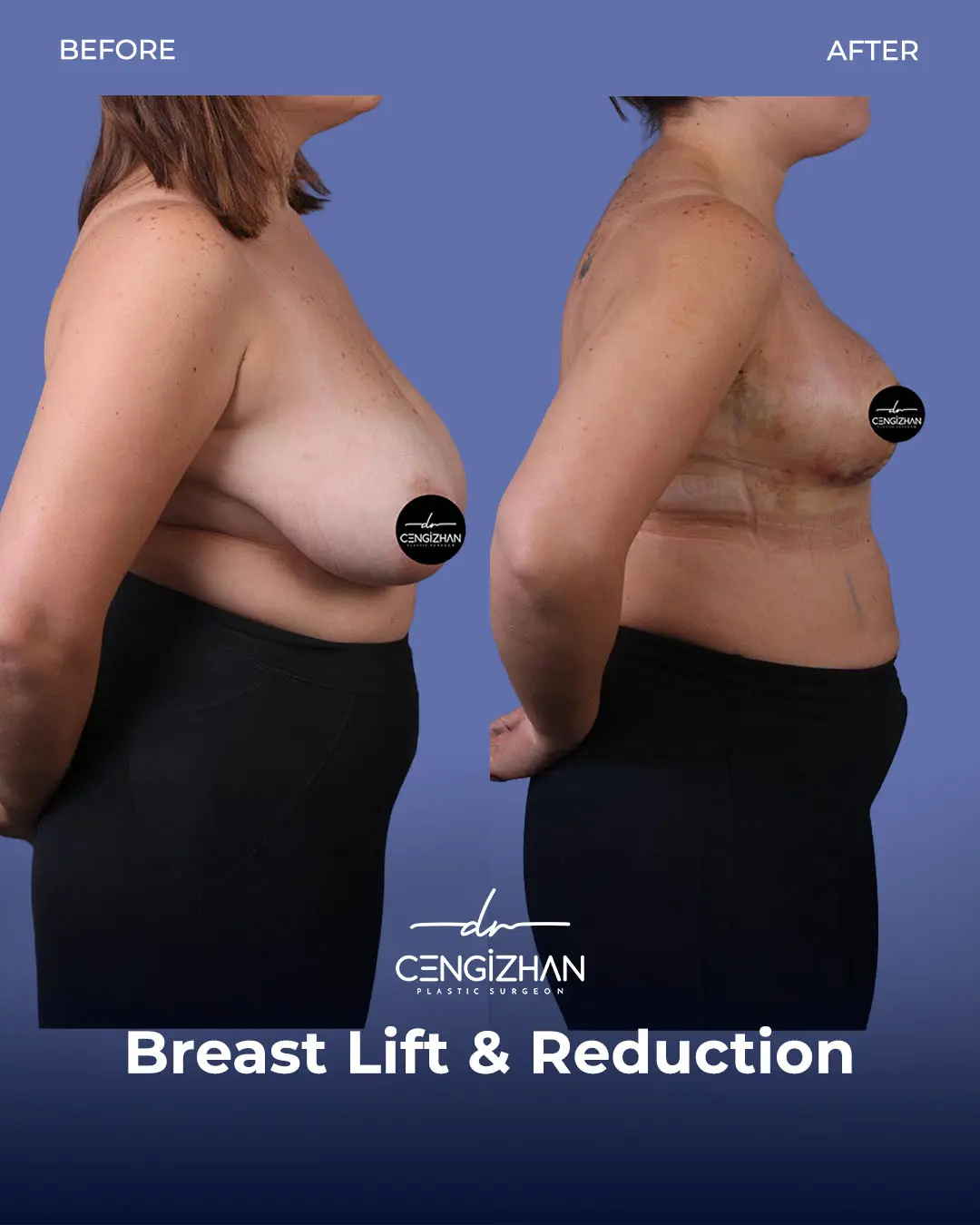 Breast Lift and Reduction Before and after photo by Dr. Cengizhan Ekizceli