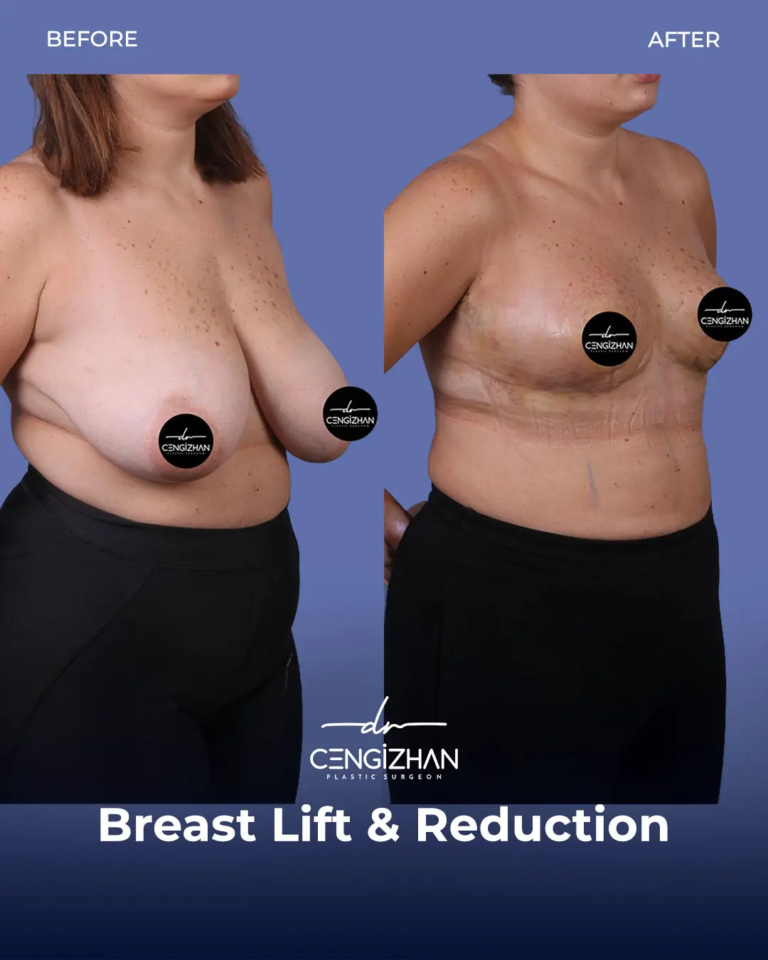 Breast Lift and Reduction Before and after photo by Dr. Cengizhan Ekizceli