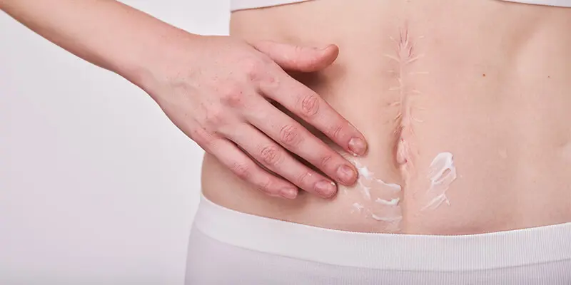 Genesung nach Bauchdeckenstraffung (Tummy Tuck) in der Türkei – Auftragen von Narbencreme auf die abheilende Bauchnarbe.