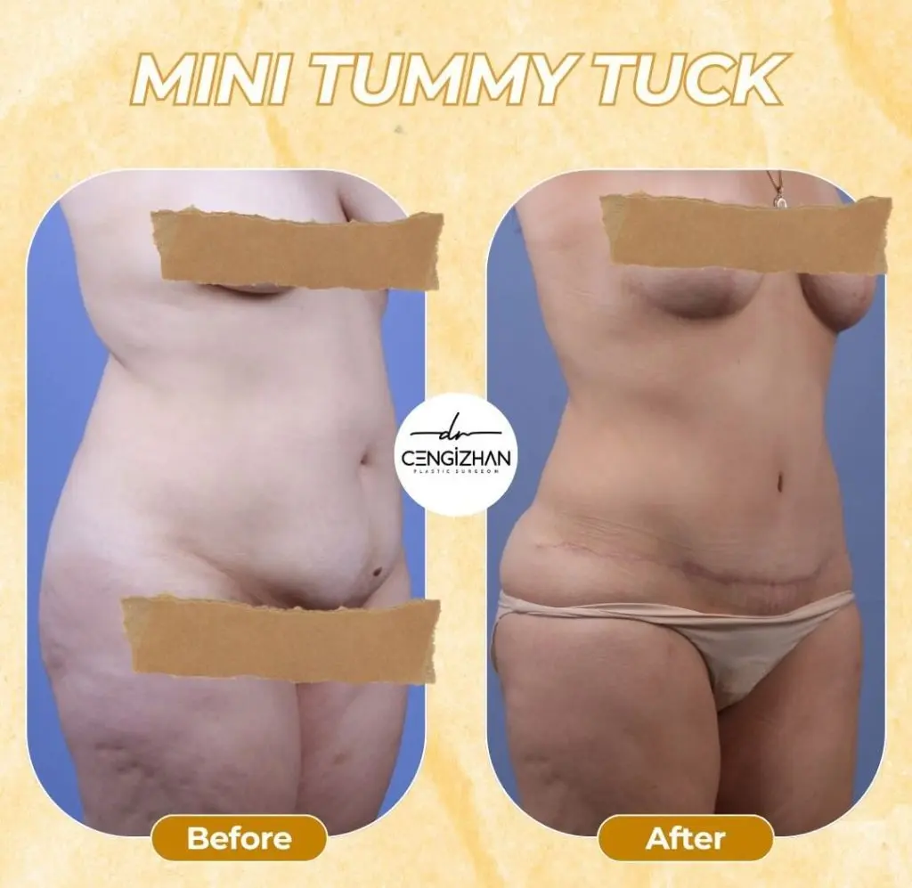 Vorher-Nachher: Mini Tummy Tuck (partielle Bauchdeckenstraffung) in der Türkei – gestraffter Unterbauch in der Seitenansicht.