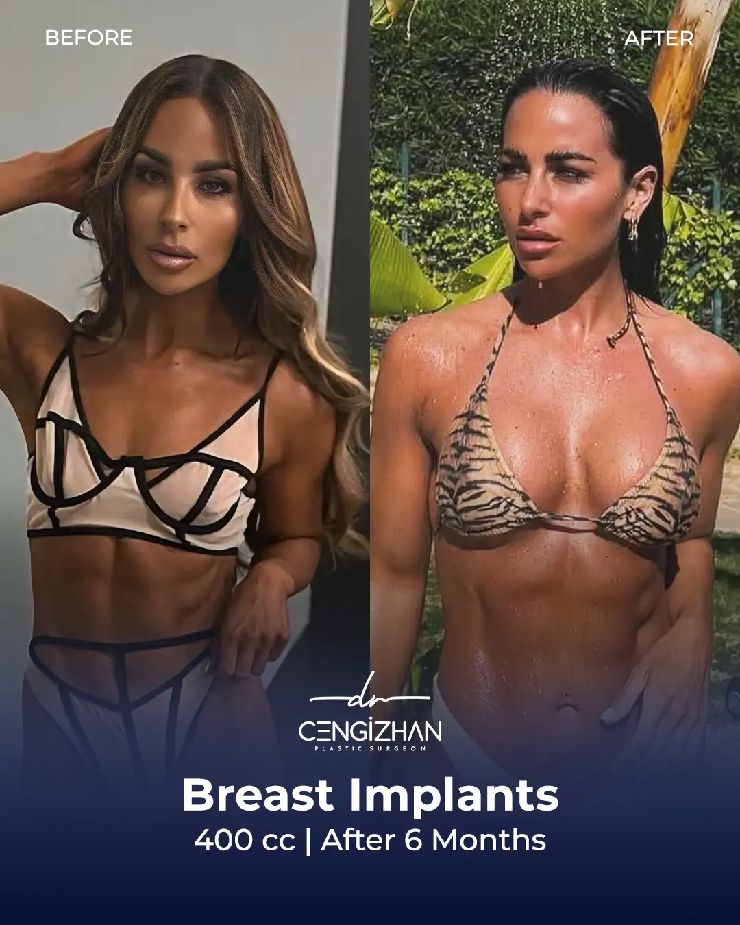 Breast Implant Before and After by Dr. Cengizhan Ekizceli