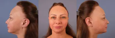 Ergebnis einer Stirnverkleinerung bei einer Frau, dargestellt aus drei Blickwinkeln: linke Profilansicht, Frontalansicht und rechte Profilansicht, mit sichtbar abgesenktem Haaransatz und harmonischeren Gesichtsproportionen.