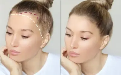 Vorher-Nachher-Vergleich einer Stirnverkleinerung bei einer Frau: Links die markierte Haarlinie mit eingezeichnetem Bereich der geplanten Stirnkorrektur, rechts das Ergebnis mit tieferem Haaransatz und verkleinerter Stirn.