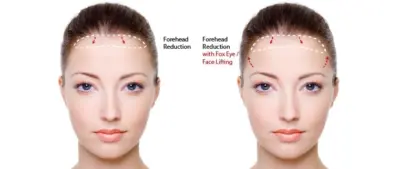 Schematischer Vergleich zweier Methoden zur Stirnverkleinerung bei einer Frau: Links die klassische Stirnverkleinerung mit Absenkung der Haarlinie, rechts die Stirnverkleinerung kombiniert mit Fox-Eye-Lifting und Face-Lifting, dargestellt durch eingezeichnete Pfeile für die zusätzliche Anhebung der Augenbrauen- und Gesichtspartie.