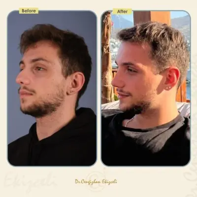 Vorher-Nachher-Vergleich einer Nasenkorrektur beim Mann in der Türkei, Seitenprofil vor und nach der Rhinoplastik