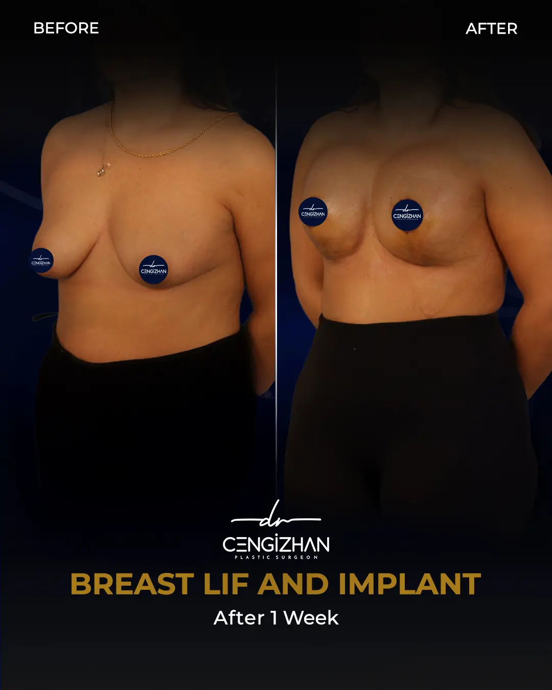 Breast Implant Before and After by Dr. Cengizhan Ekizceli