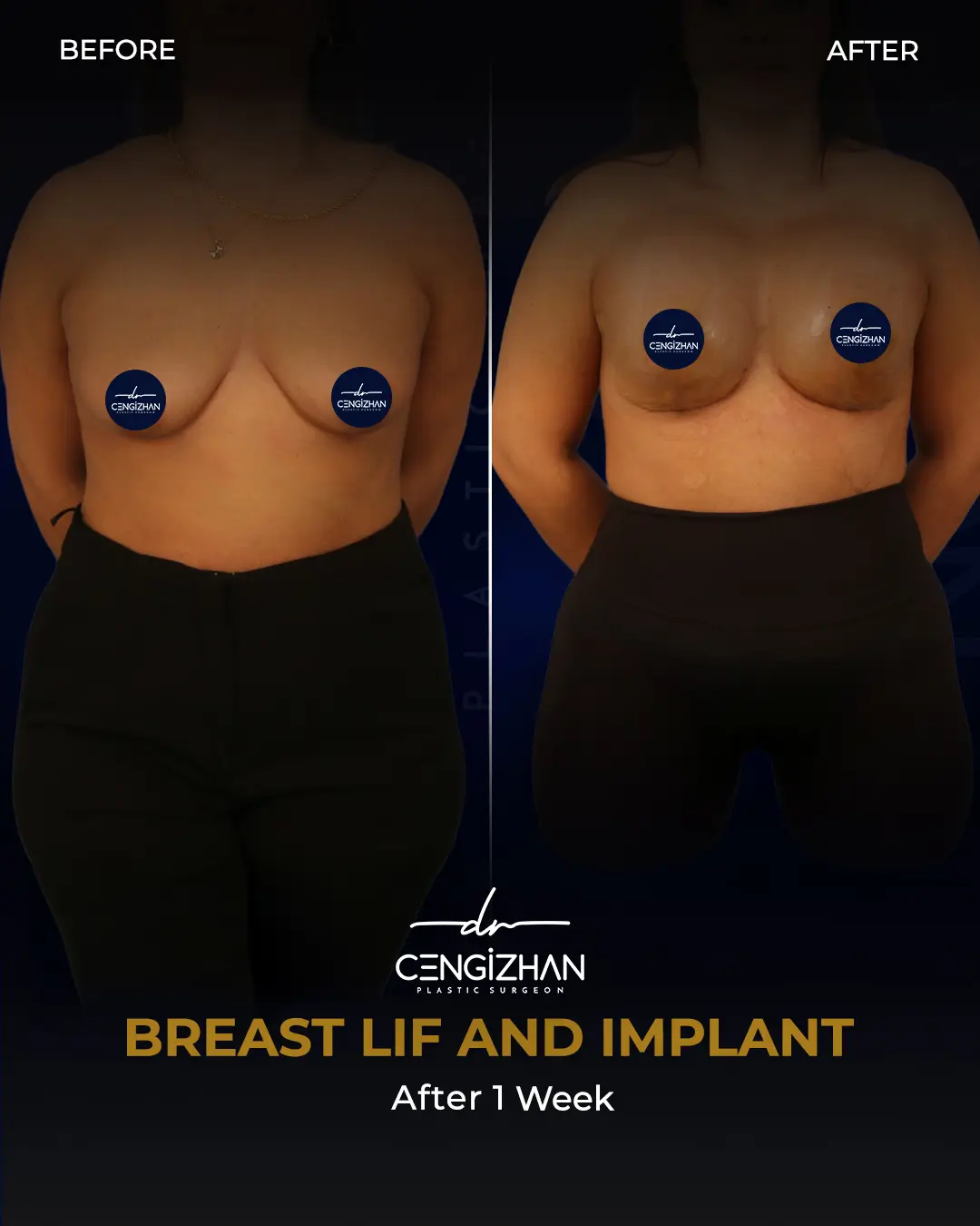 Breast Implant Before and After by Dr. Cengizhan Ekizceli