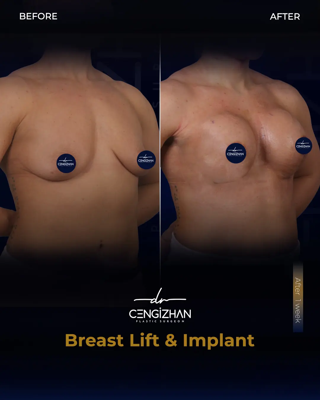 Breast Implant Before and After by Dr. Cengizhan Ekizceli