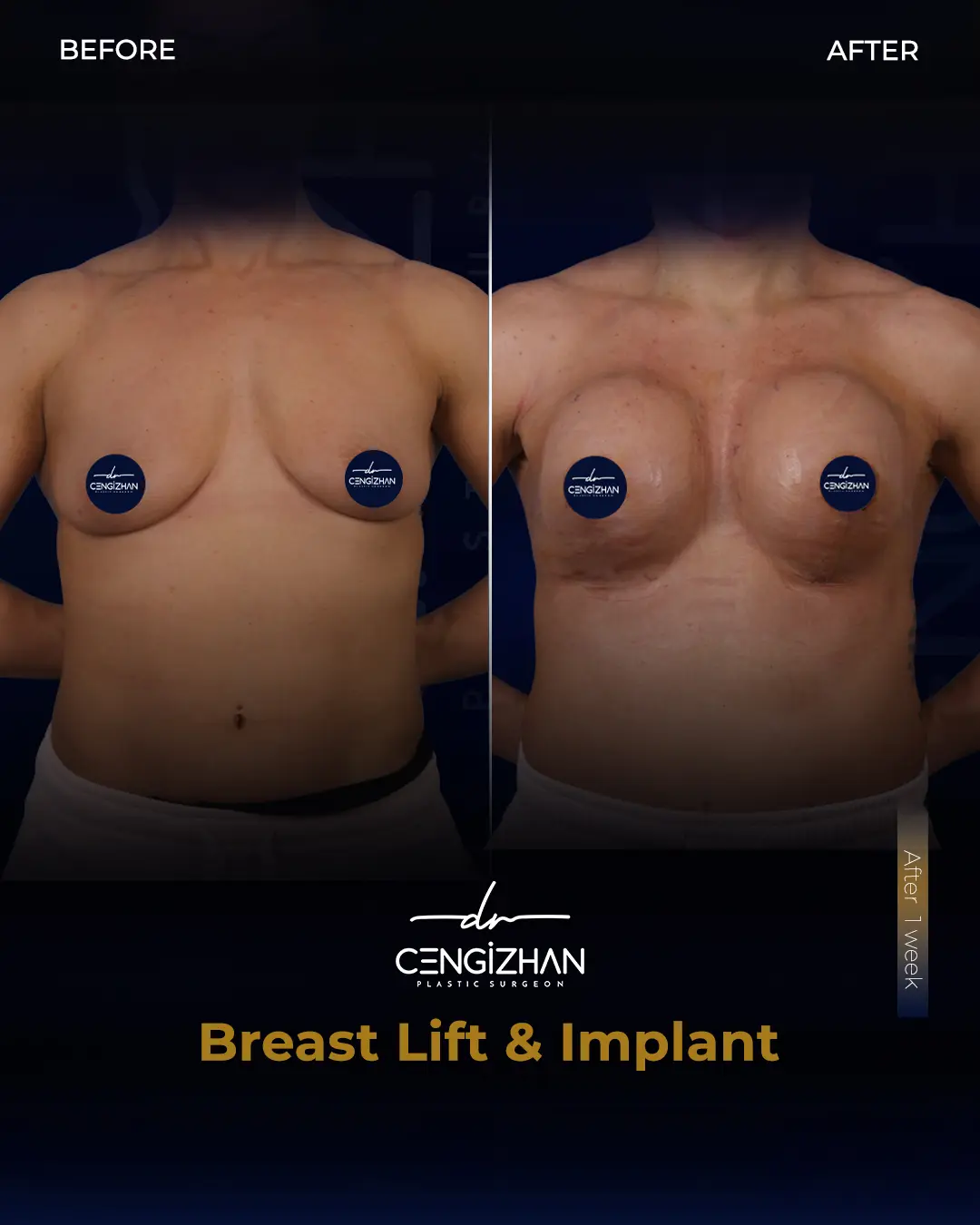 Breast Implant Before and After by Dr. Cengizhan Ekizceli