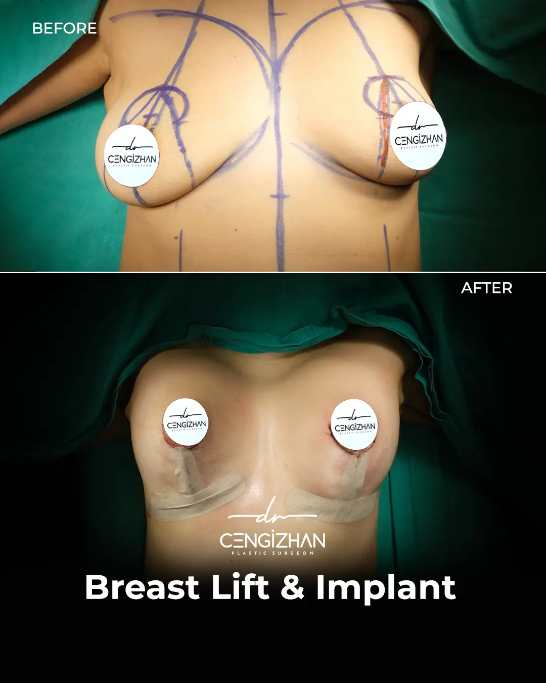 Breast Implant Before and After by Dr. Cengizhan Ekizceli