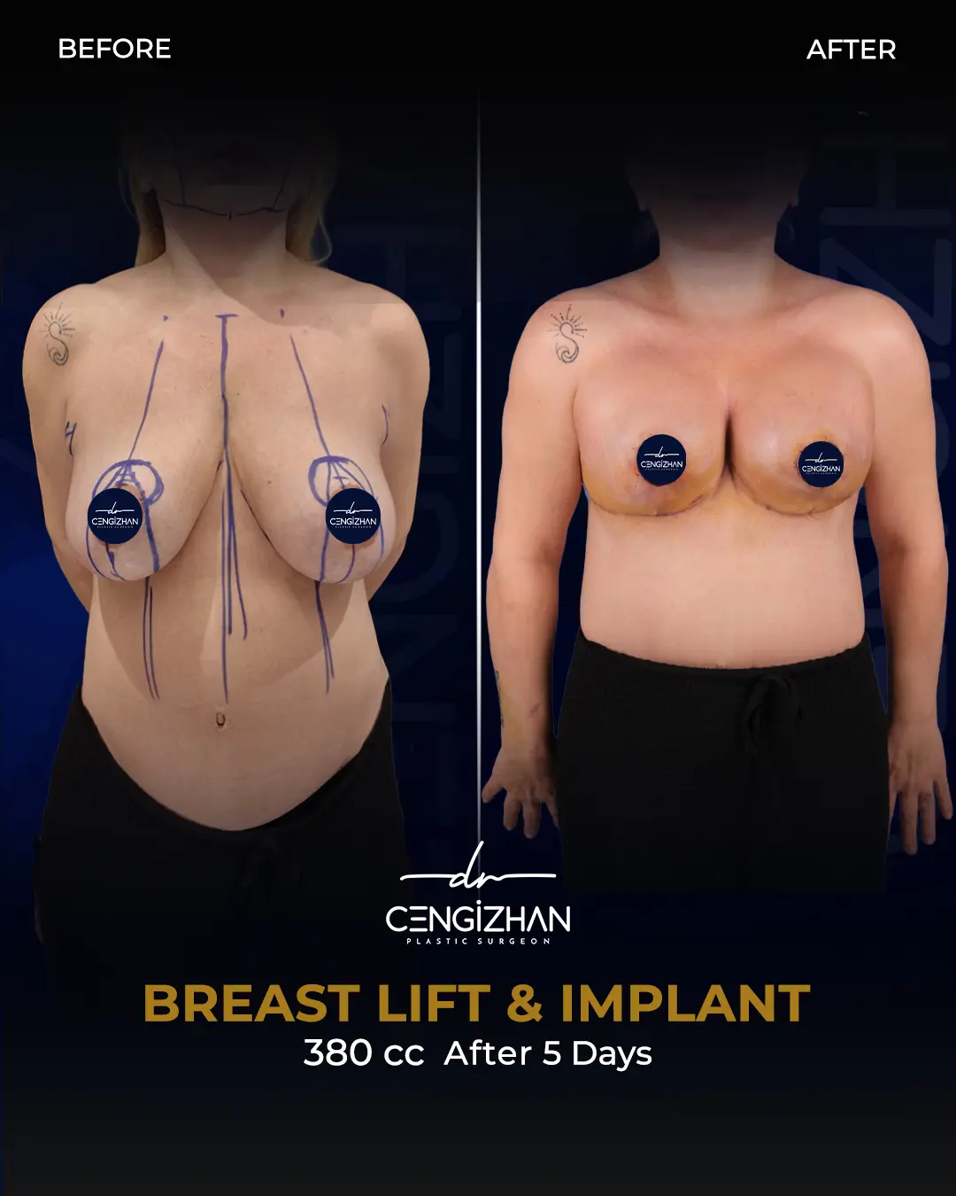 Breast Implant Before and After by Dr. Cengizhan Ekizceli