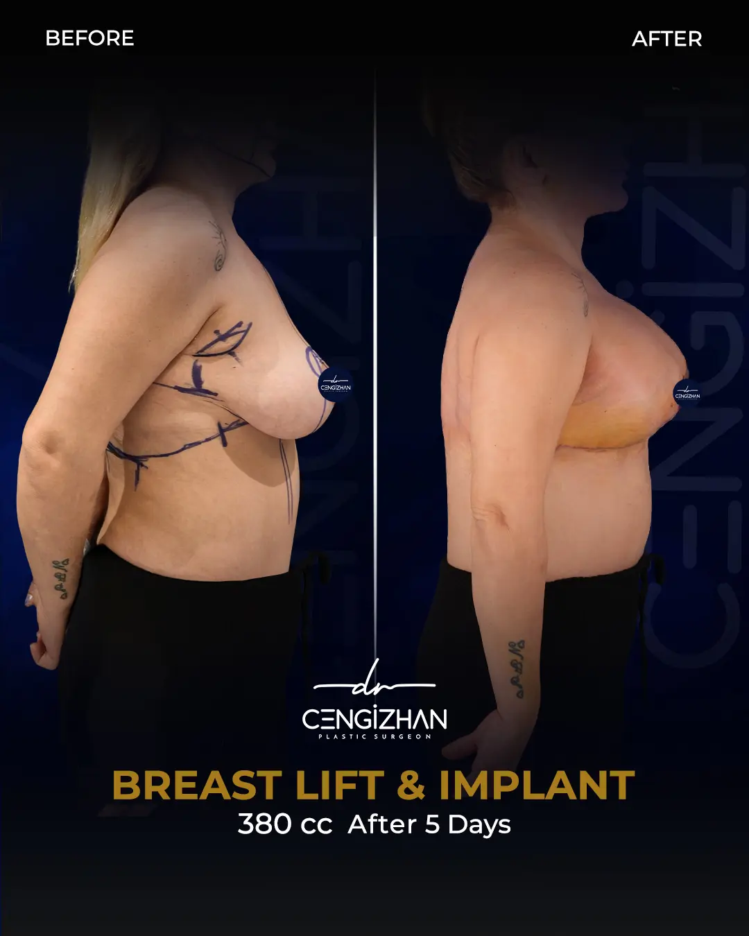 Breast Implant Before and After by Dr. Cengizhan Ekizceli