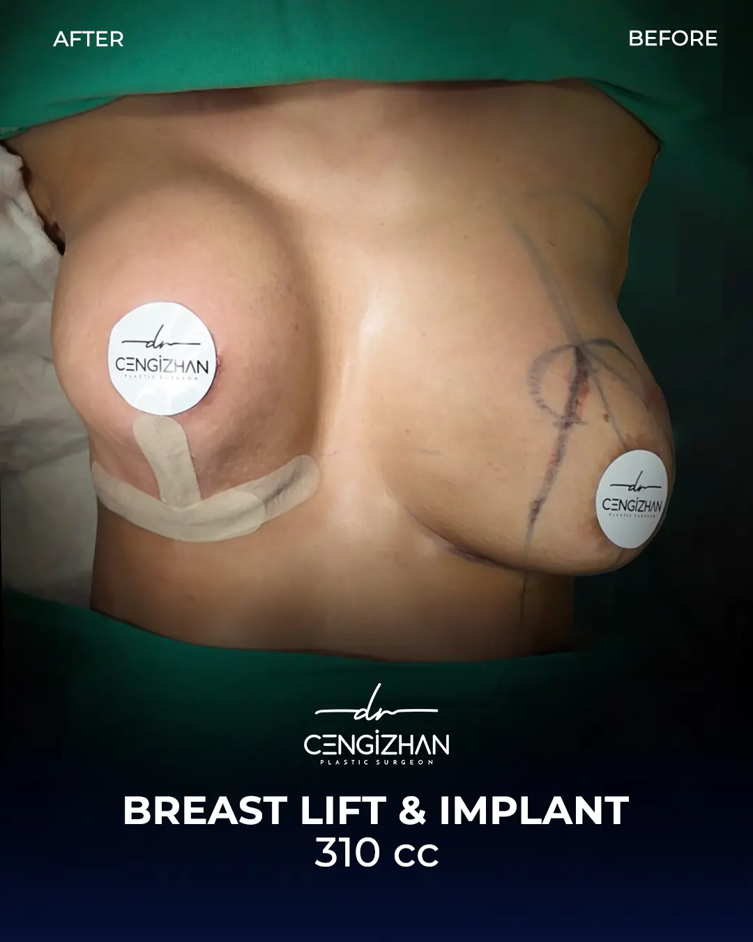 Breast Implant Before and After by Dr. Cengizhan Ekizceli