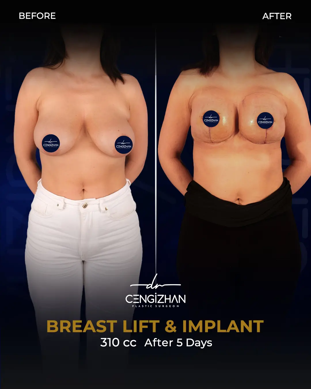 Breast Implant Before and After by Dr. Cengizhan Ekizceli