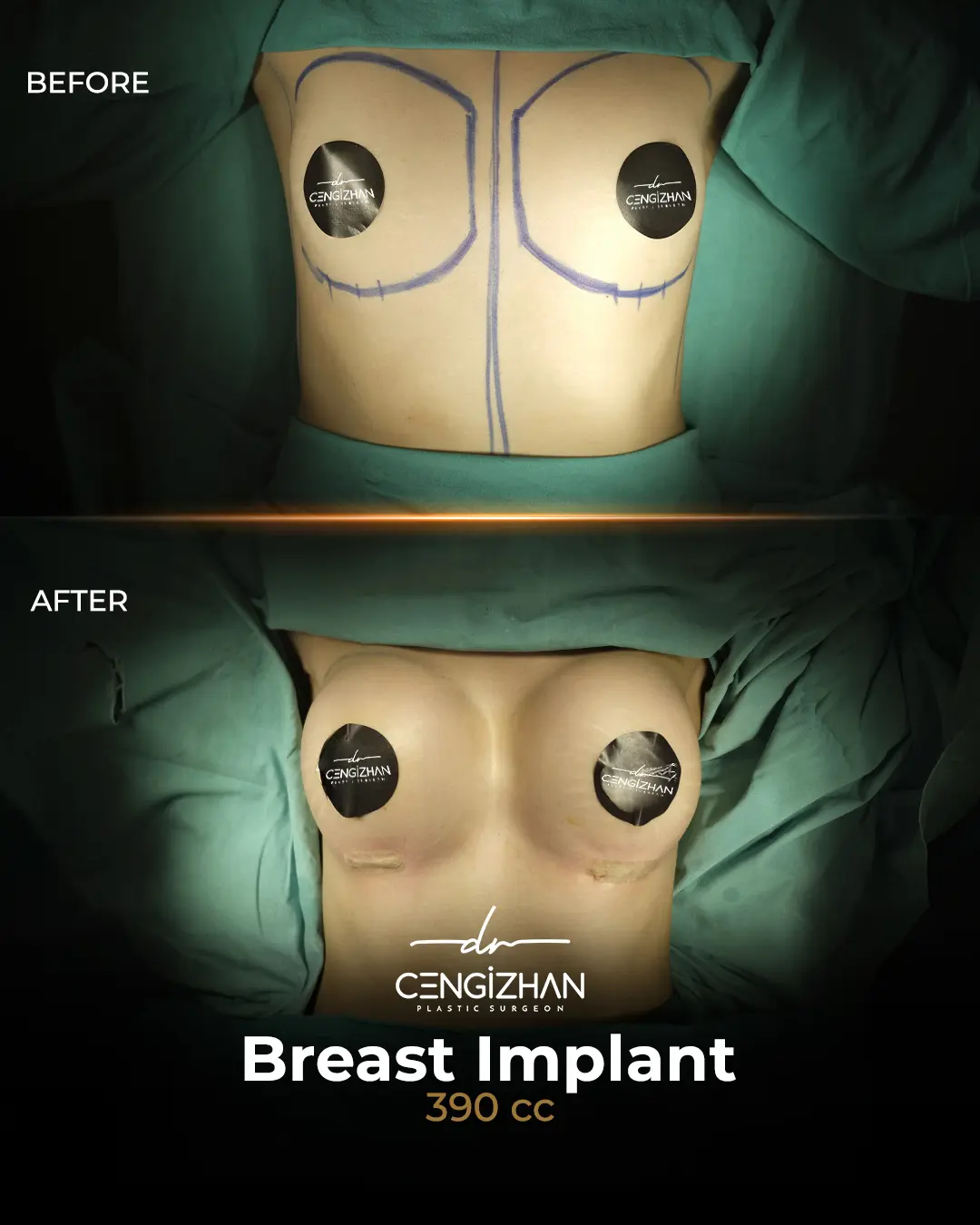 Breast Implant Before and After by Dr. Cengizhan Ekizceli